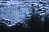 Nodular Tumour,Ultrasound