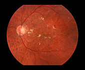 Diabetic Retinopathy,3 of 5