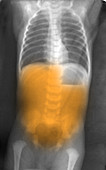 Pyloric Stenosis,Abdomen X-ray