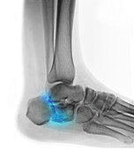 Fractured Heel,X-ray
