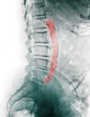 Calcified Aorta,Lumbar X-ray