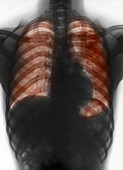 X-ray Showing Tuberculosis