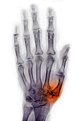 Arthritis in Hand,X-ray