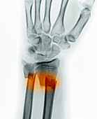 Forearm Fracture,X-ray
