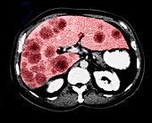 Metastatic Liver Cancer,CT