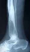 Osteomyelitis of Tibia,X-ray