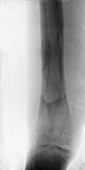 Osteomyelitis of Tibia,X-ray