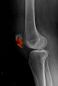 Patella Fracture,X-ray