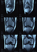 MRI of a knee