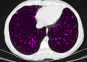 Cystic Fibrosis,CT Scan of Chest