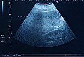 Hepatomegaly,pelvic ultrasound