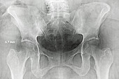 Asymmetrical Hips,X-ray