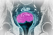 Cervical Cancer,MRI