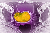 Cervical Cancer,MRI