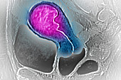 Uterine cancer,MRI