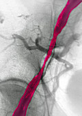 Stenosis,angiogram