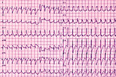 Tachycardia,ECG
