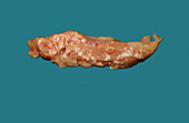 Pancreatitis,Gross Specimen