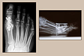 Arthrodesis Operation,X-rays