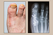 Foot 10 Weeks Post-Arthrodesis Op