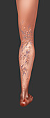 Varicose veins,Illustration