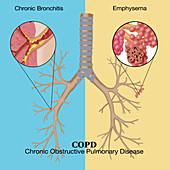 Chronic Pulmonary Disease,Illustration