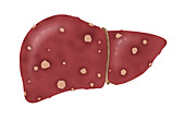 Liver Stage 2 Cirrhosis,Illustration