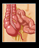 Normal Appendix,Illustration
