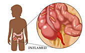 Inflamed Appendix,Illustration