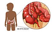 Ruptured Appendix,Illustration