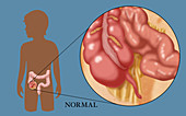 Normal Appendix,Illustration