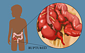 Ruptured Appendix,Illustration