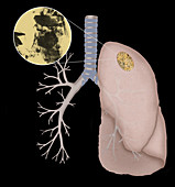 Asbestosis,Illustration