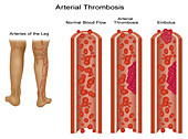 Leg Blood Clots,Illustration