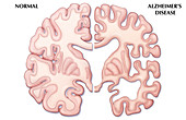 Alzheimer's Disease Brain,Illustration
