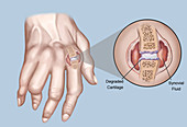 Rheumatoid Arthritis,Illustration