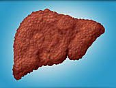 Cirrhotic Liver,Illustration
