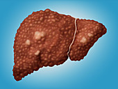 Hepatocellular Carcinoma,Illustration