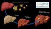 Liver Damage in Hepatitis C,Illustration