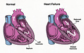Healthy and Failure Hearts,Illustration