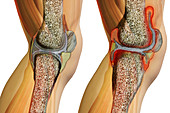 Systemic Juvenile Arthritis,Illustration
