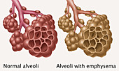 Alveoli and Emphysema,Illustration