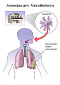 Asbestos and Mesothelioma,Illustration