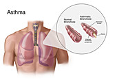 Asthma and Bronchioles,Illustration