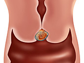 Cervical Ectopic Pregnancy,Illustration