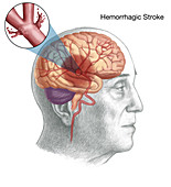 Haemorrhagic Stroke,Illustration