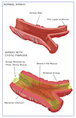 Cystic Fibrosis,Illustration