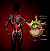 Causes of Back Pain,Illustration