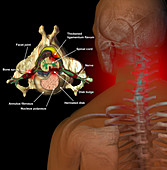 Neck Pain,Illustration