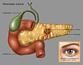 Pancreatic Cancer,Illustration